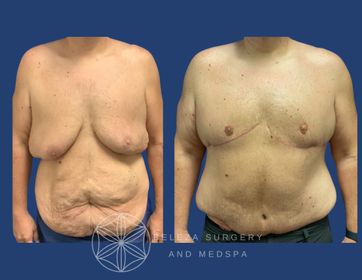 Patient 7 Panniculectomy (1).jpg