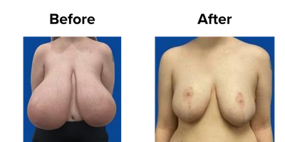 Breast (5).png