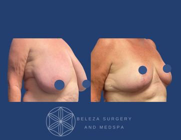 Patient 13 Breast Reduction Right 45.jpg