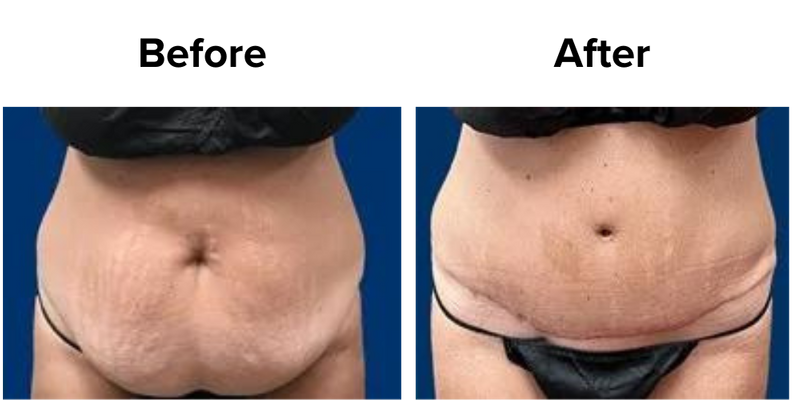 Tummy Tuck (2).png