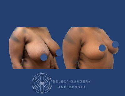 Patient 1 Breast Reduction Right 45 (2).jpg