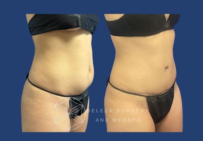 PATIENT 18 Adominoplasty Right angle.jpg