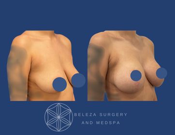 Mastopexy Augmentation Patient 4 Right Angle (1).jpg