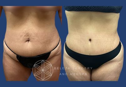 Patient 4 Abdominoplasty (2).jpg