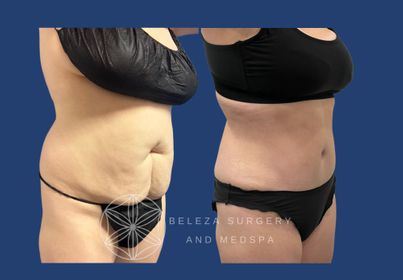 PATIENT 17 Abdominoplasty Right angle.jpg