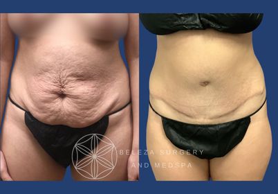 Patient 7 Abdominoplasty (1).jpg