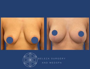 Mastopexy Augmentation Patient 4 Anterior (1).jpg