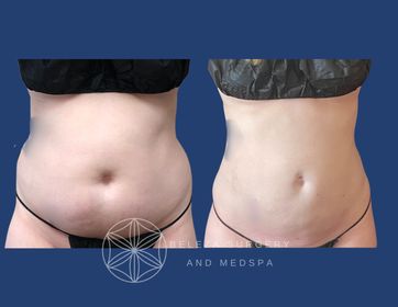 Patient 29 Liposuction Anterior  (1).jpg