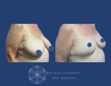 Patient 3 Breast Reduction Right 45 (1).jpg