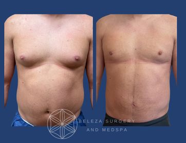 Patient 3 Gynecomastia (1).jpg