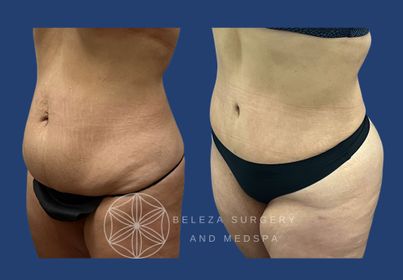 PATIENT 4 Abdominoplasty Left angle.jpg