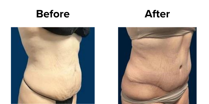 Tummy Tuck (4).png