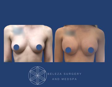 Patient 12 Breast Augmentation - Anterior (1).jpg