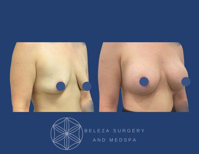 Patient 3 Breast Augmentation - Right Angle.jpg