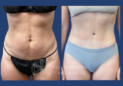 Patient 12 Abdominoplasty (3).jpg