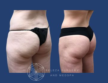 Patient 12 BBL Left (1).jpg