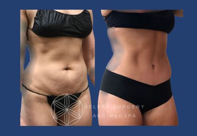 PATIENT 3 Abdominoplasty Right angle.jpg