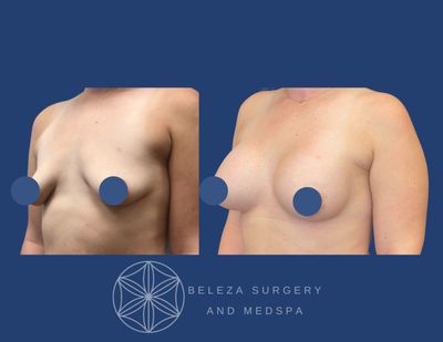 Patient 8 Breast Augmentation - Right Angle.jpg