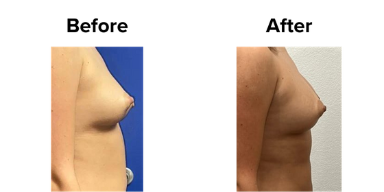 Fat Transfer.png