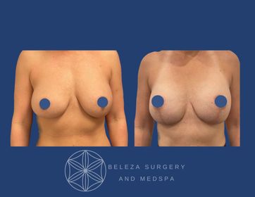 Patient 5 Mastopexy Anterior.jpg