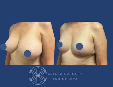 Patient 5 Breast Reduction Right 45.jpg