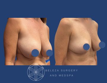 Patient 18 Breast Reduction Right 45.jpg
