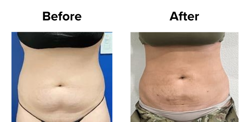 Liposuction (1).png