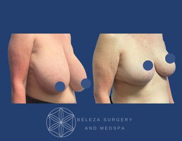 Patient 7 Breast Reduction Right 45.jpg