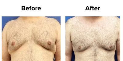 Breast (10).png