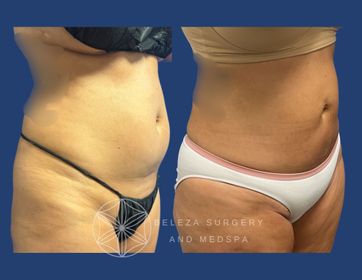 Patient 22 Right Oblique.jpg