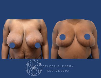 Patient 1 Breast Reduction Anterior (1).jpg