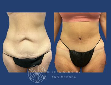 Patient 3 Panniculectomy (1).jpg