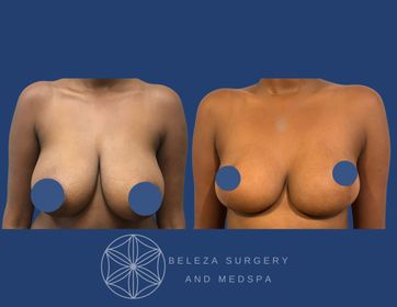 Patient 17 Breast Reduction Anterior.jpg