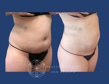 Patient 29 Liposuction Right angle (1).jpg