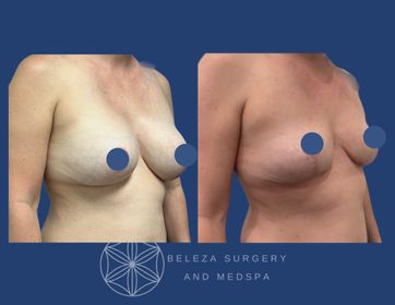 Patient 8 Explant Mastopexy Right.jpg