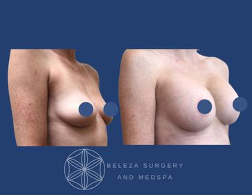 Patient 9 Breast Augmentation - Right Angle.jpg