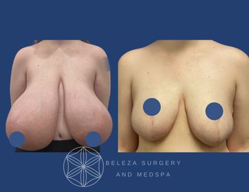 Patient 6 Breast Reduction Anterior.jpg