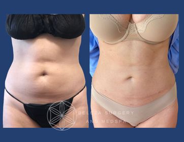 Patient 25 Lipo 3AA (1).jpg