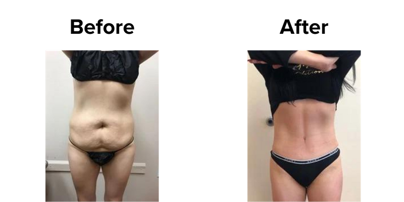 Tummy Tuck (5).png