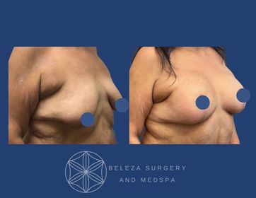 Mastopexy Augmentation Patient 2 Right Angle (1).jpg