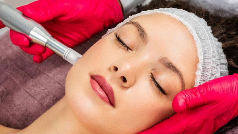 woman receiving microneedling treatment