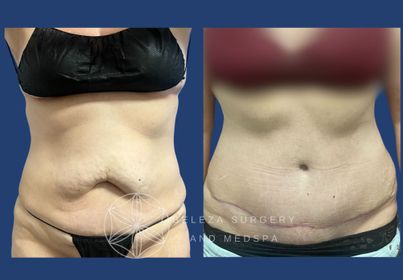PATIENT 13 Abdominoplasty Anterior.jpg