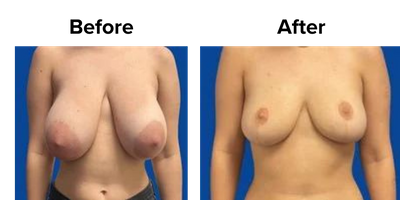 Breast (4).png