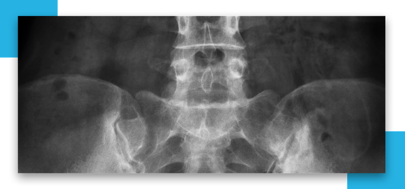 OrthoDx: Acute Lumbar Compression Fracture - Clinical Advisor