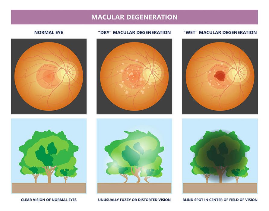 macular-degeneration.jpg