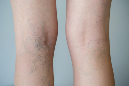 Are_You_a_Candidate_for_Sclerotherapy_Vein_Treatment_637728224862810400.png