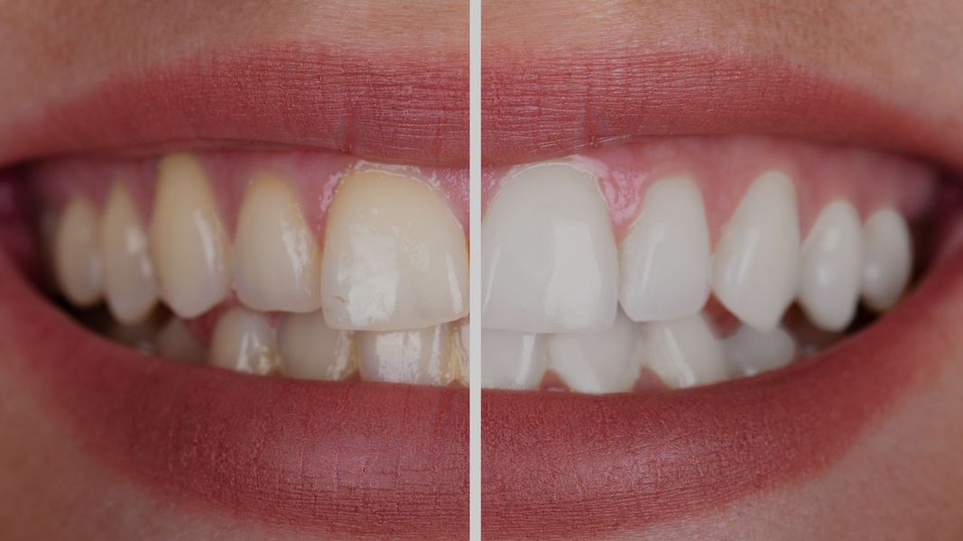 side by side comparison of yellow and white teeth