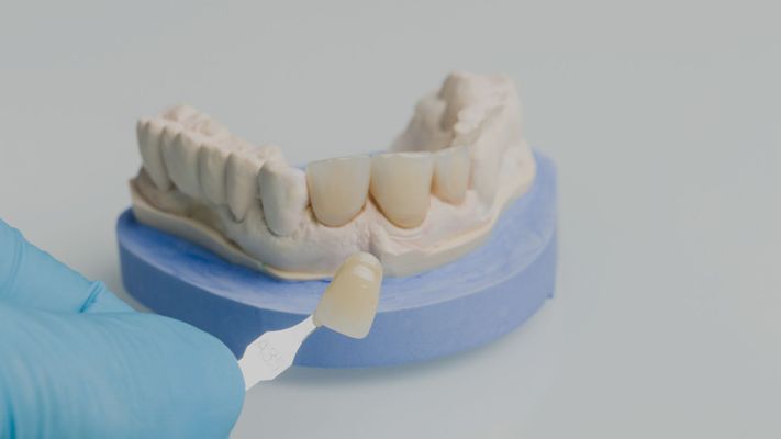 veneer next to mold of teeth