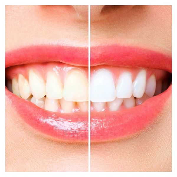 before and after of teeth whitening