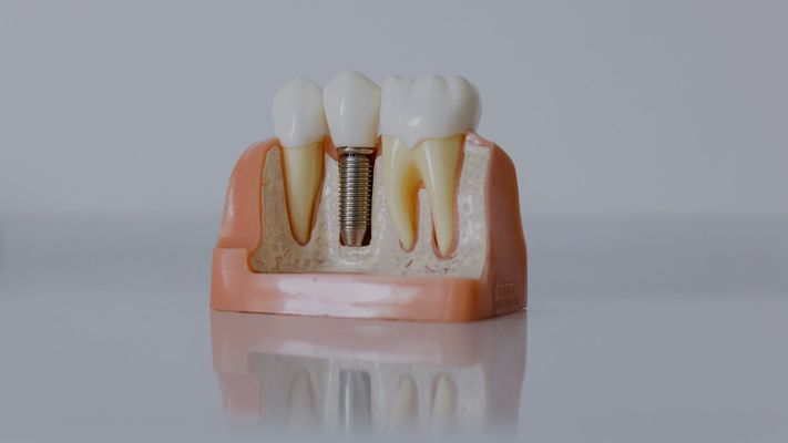 dental implants